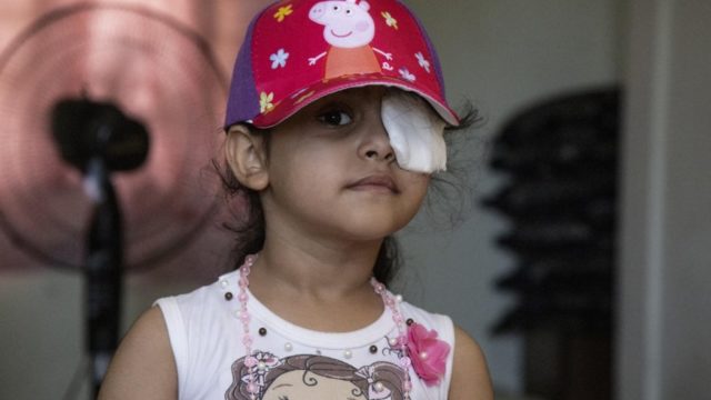 Sama porte un pansement à l’oeil gauche après avoir été blessée au cours de l’explosion